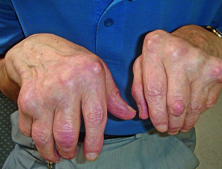 Mida artriit sormedega valja naeb