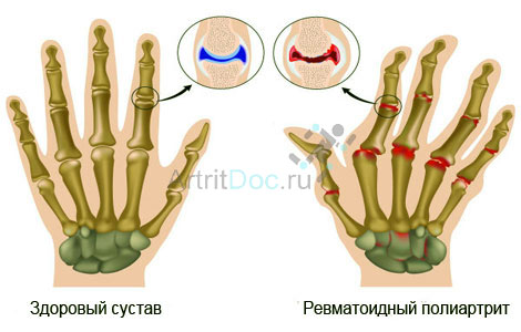 Mida teha sorme liigese vigastusega