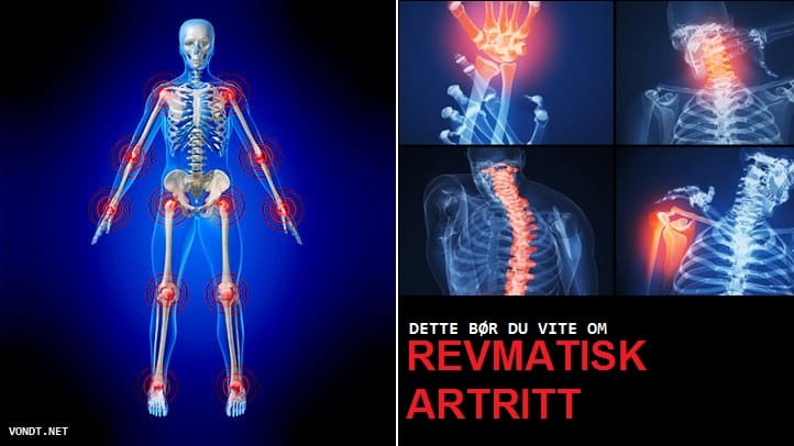 Ravi liigeste artriidi ja artriidi ravi