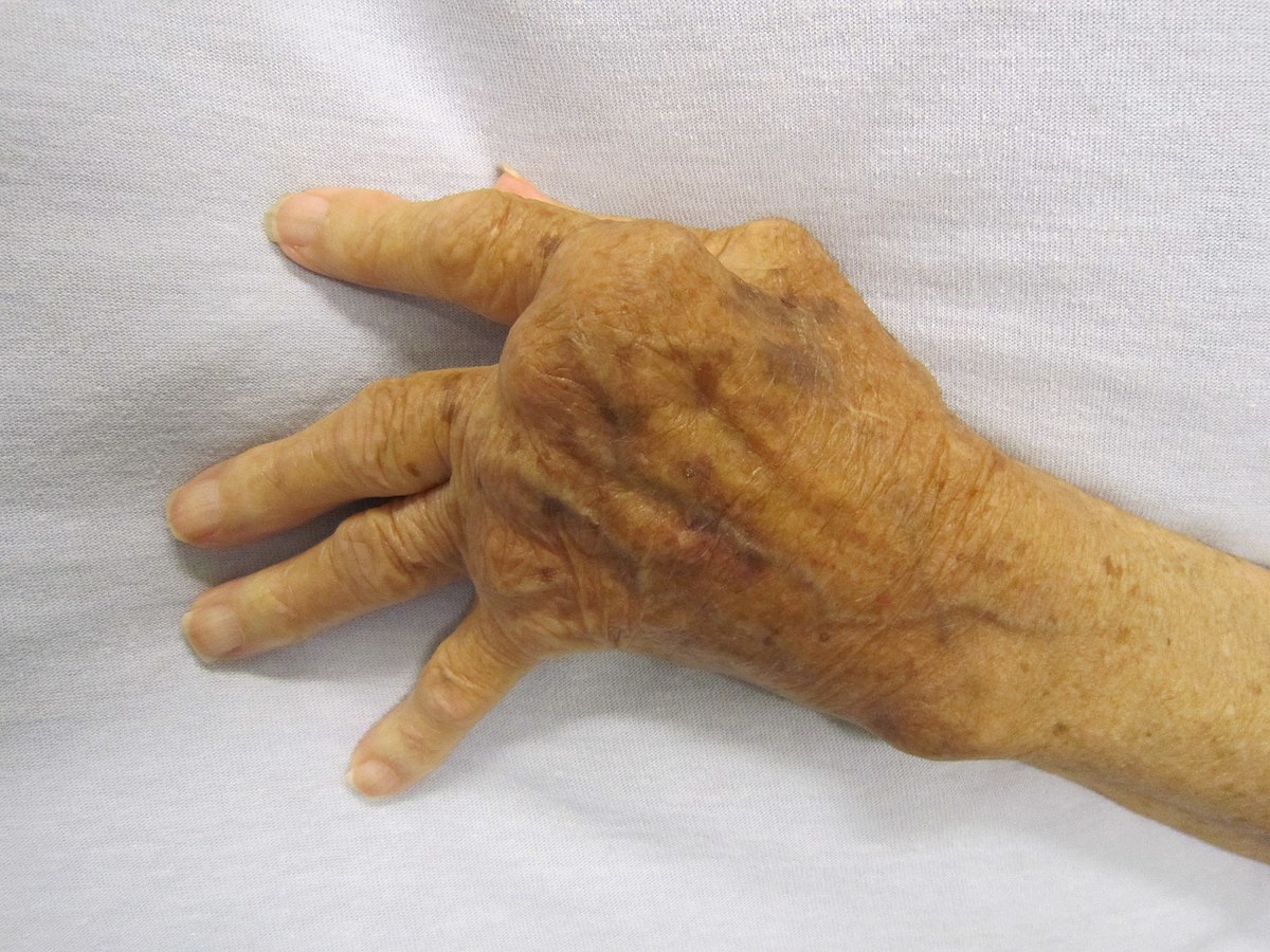 Rheumatismi artriidi artriidi ravi haiget reieluu liigeste parast jooksmist