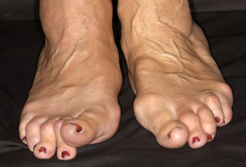 Mis on jala artriit hakkavad liigeste haiget tegema