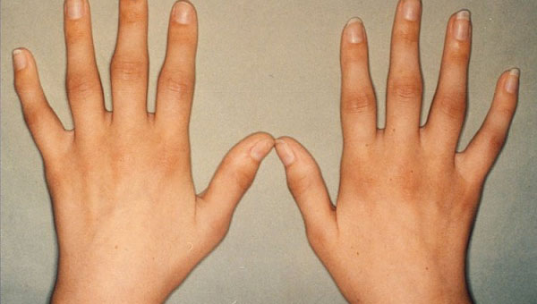 Sormede liigeste artriit Artriit ja artroosi sormede ravi