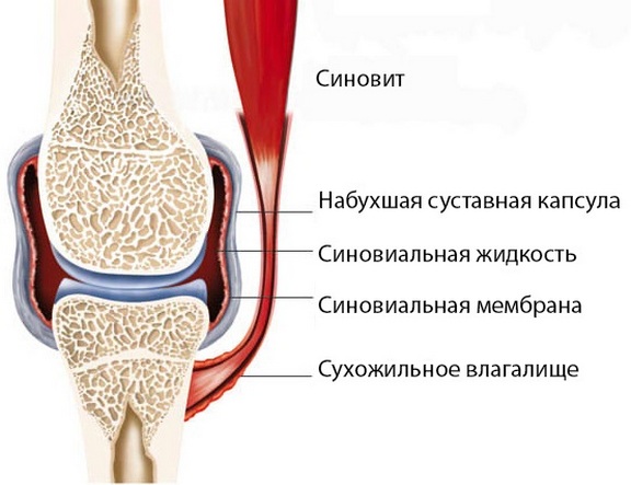 Paisuva liigese deformatsioon Anesteseerimine ola liigese artroosiga