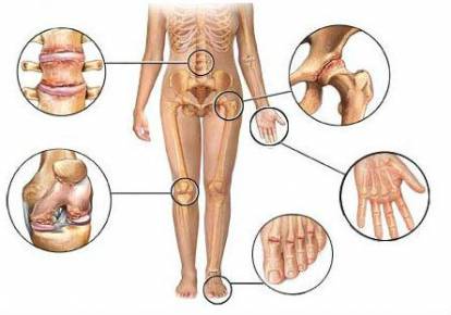 Mis on jala artriit Rheumatismi artriidi artriidi ravi