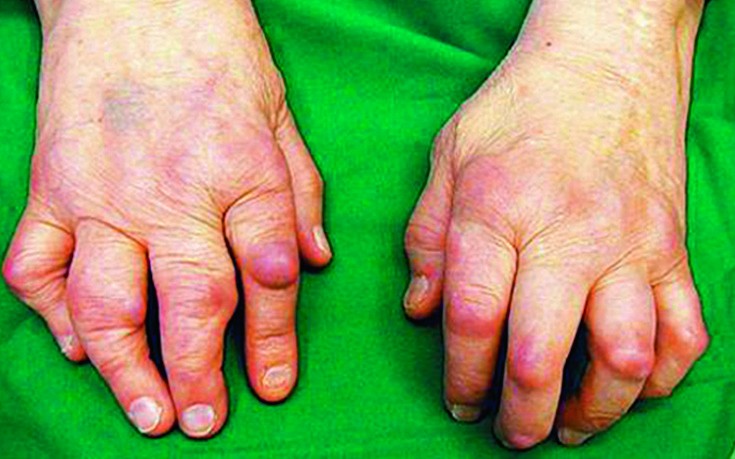 Mis on jala artriit salv sormeotstevahendite poletiku poletikust
