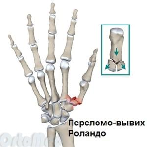Mida teha sorme liigese vigastusega