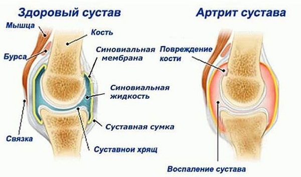 Valu kimbud liigesed Mis vahe on arthroosi artriidi vahel