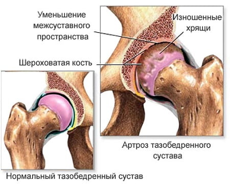 Sakme artroosi ravi Mida teha, kui see on valus ray-mahuti liigese
