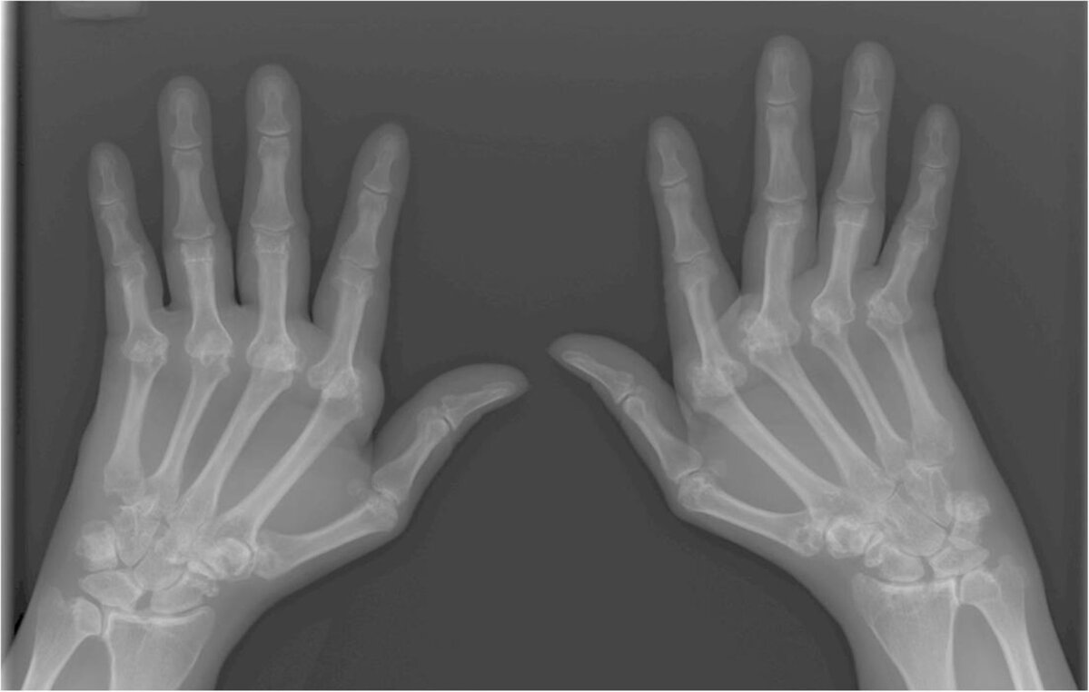Valutab vasakpoolse sorme liigese Vaikeste liigeste reumatoidartriit