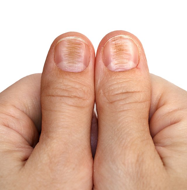 Artriidi nakkuslikud sormed VMM liigeste ulevaatuste raviks