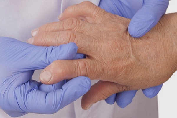 Artriidi sormede harja ravi