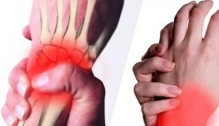 Kuidas ravida polvevalu polve artroosis