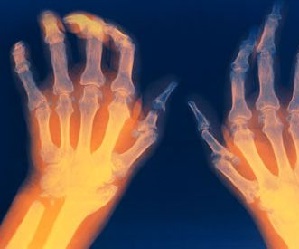 Ravi liigeste artriidi ja artriidi ravi