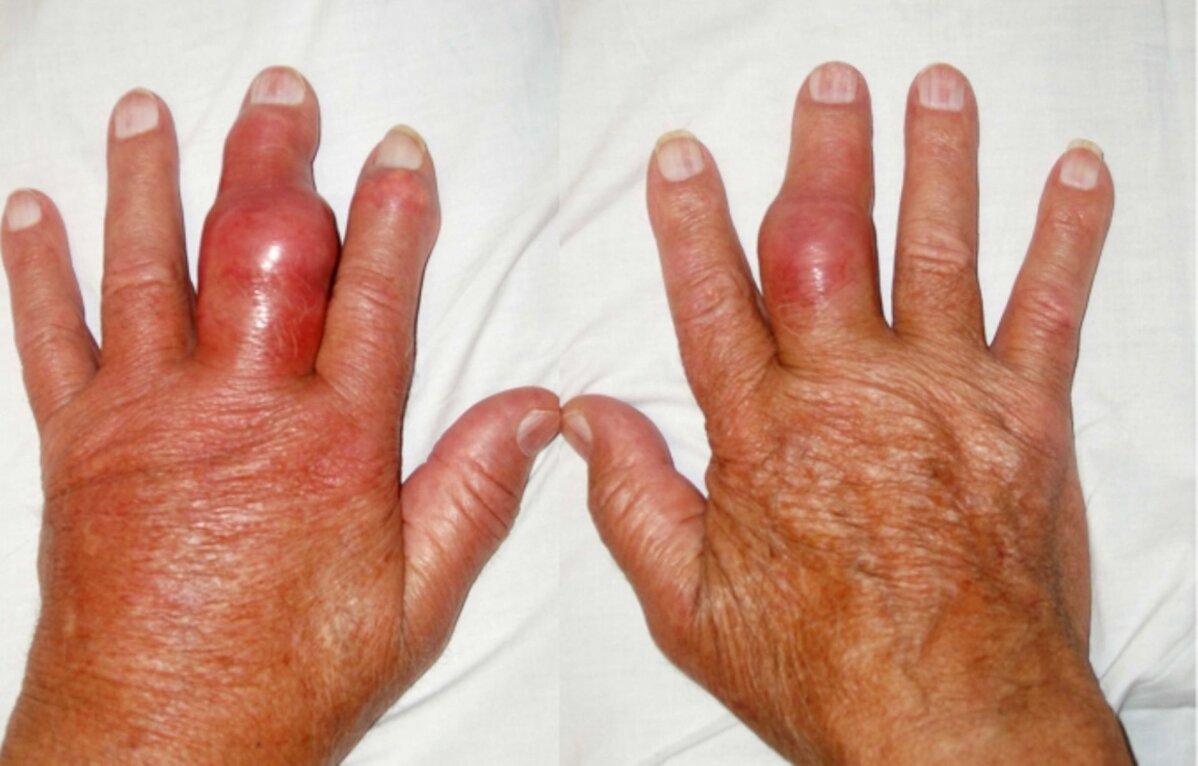 Terav valu keskmise sorme liigesevalu