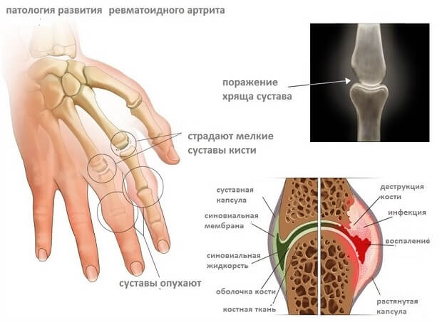 Valu kate sormede liigestes paindumisel ja pikendamisel