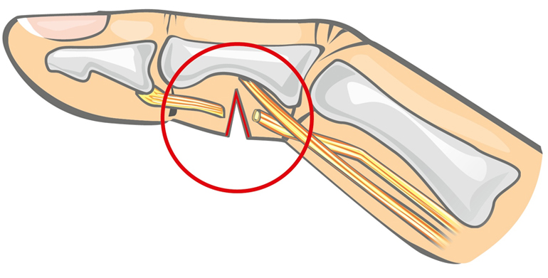 Kuidas maarata ola liigese artroosi Kaasaegsed valuvaigistid, kellel on liigeste valu