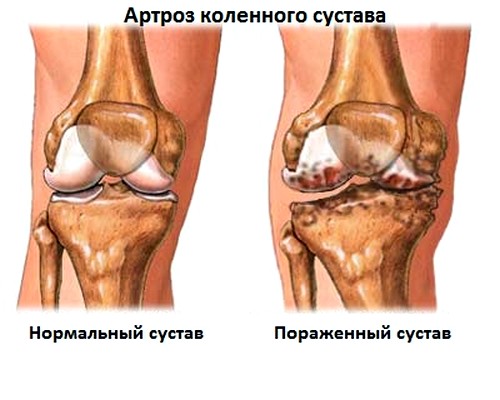 Vaikeste liigendite artroosi vasak jalgsi Mida teha, kui artriit kaed