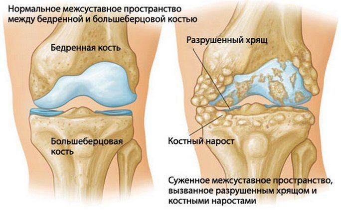 Artroosi vasakpoolne jalgravi Toetab jalgadel haiget, kuidas tugevdada