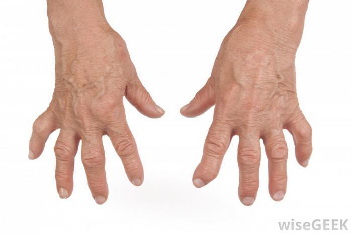 Hoidke liigeseid Falangie sormedesse Osteokondroosi soojendav geel