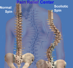 Spin Hurt Scoliosis