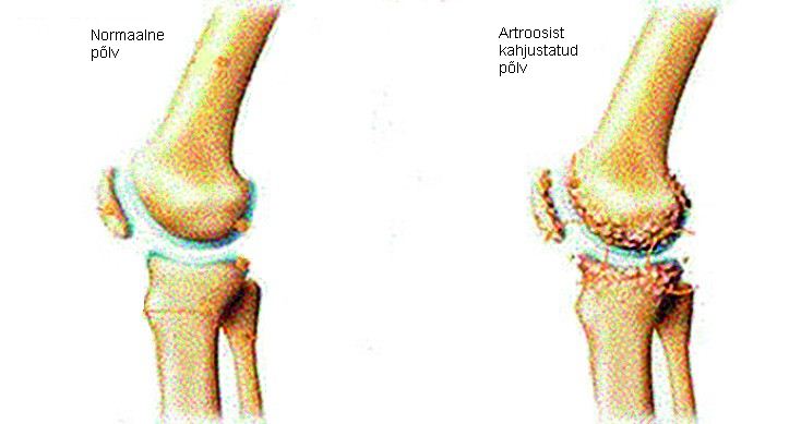 Tweet Bone Foot-ravi artroos Retsepti salvi osteokondroosiga