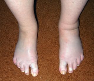 Folk meetodid jala liigeste raviks Salvestage salvi liigestele