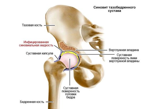 Liigeste artroos wiki Tseljabinski ravi liigeste