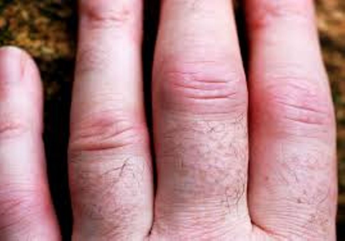 Artriit sormedes Kuidas maarata Vaikeste liigendite ravi artriit