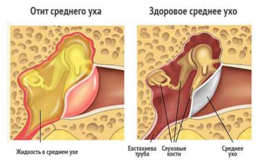 Esimese Tibaliigese artroos