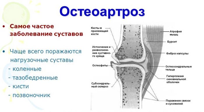 Liigeste artroosi ravis diagramm Eboniidi liigeste ravi