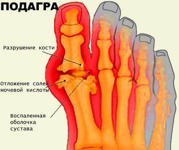 Meetodid liigeste raviks kodus Hoidke sormede ja jalgade liigeseid