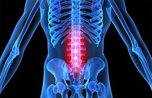 Osteokondroosi kreemid ja salvid Mis on kuunarnuki liigeste artroos