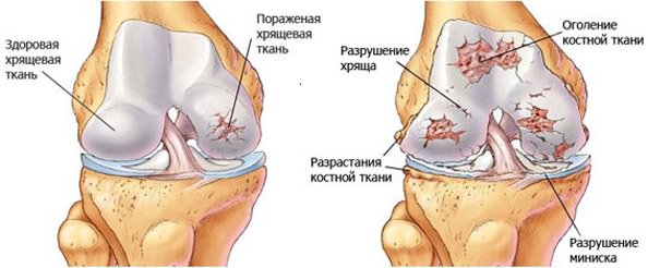 Vaikeste liigendite artroosi jalgsi
