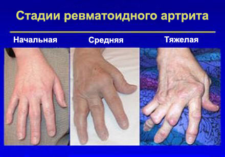 Sorme pohjuse liigese artriit Lomiti liigesed kahjustavad kate sormed, mis voiksid olla